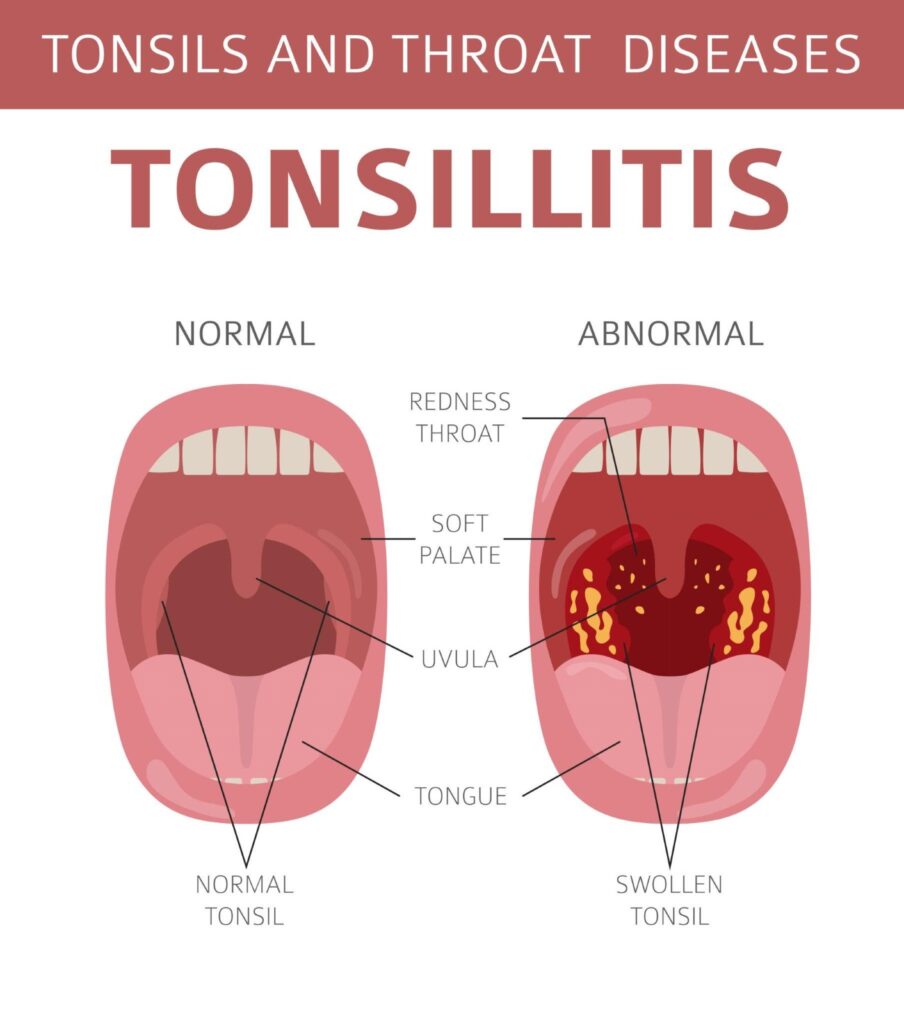 Tonsils