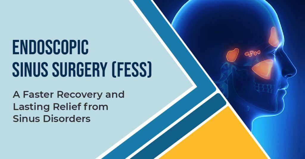 Endoscopic sinus surgery (FESS) illustration showing sinus anatomy for minimally invasive treatment of chronic sinus disorders.